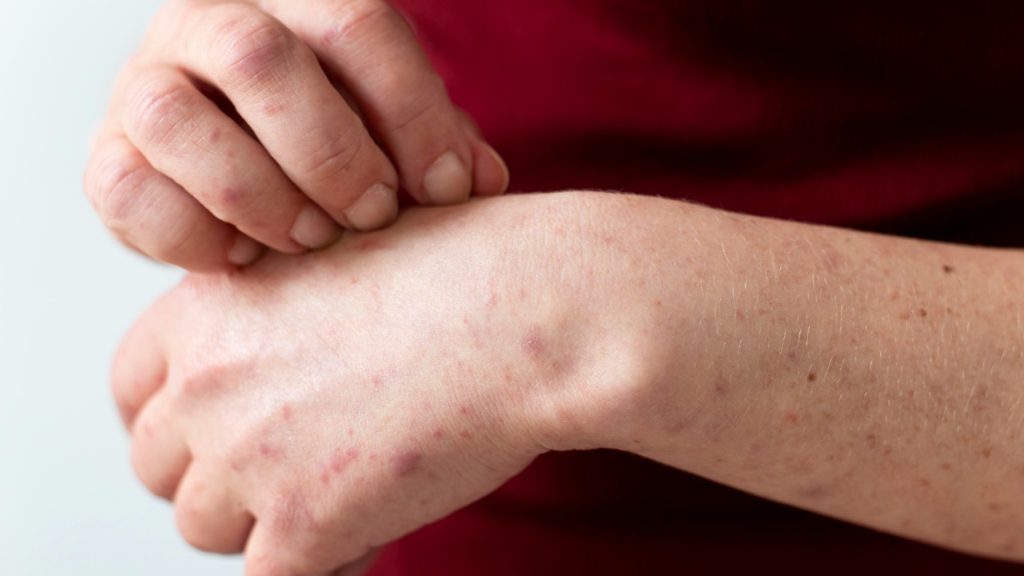 Casos-en-nuevo-león-sarampión-esquema-de-vacunación-influenza